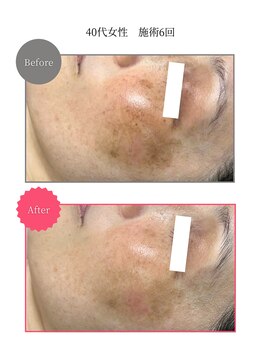 ボータン 恵(Beau Temps)/ウルトラ光トーニング/シミ改善