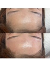 ラティーク 諫早西口店/マリムーブフェイシャルWAX