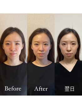 ハリカ 大阪梅田店(HARIKA)/美容鍼の翌日の変化がすごい!