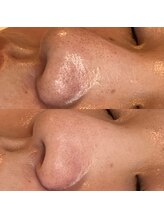 アトリエドゥアージュ(Atelier de age)/フェイシャルWAX