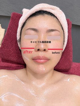 ミッシュ(Mish)の写真/【大気汚染物質や余分な皮脂や角質を取り除く】セルキュア4++美顔器で美肌&フェイスラインのたるみも綺麗に