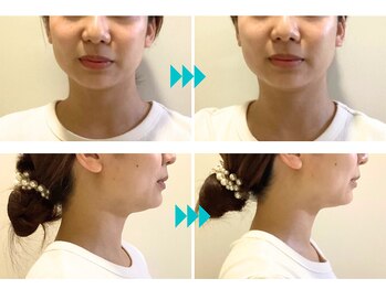 コルギ専門店 マキシフォート 栄店(Maxifort)/あごラインをシュッと！