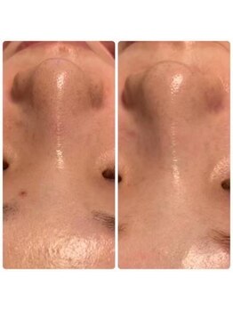 ミュー パピヤン(mue papillant)/ビフォーアフター【毛穴】