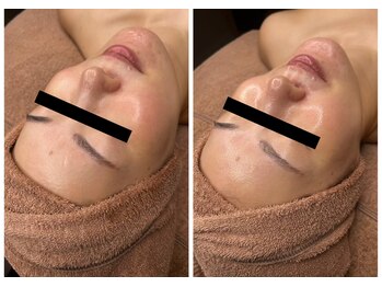 エクラルム(Eclaleum)/BeforeAfter　ララピール