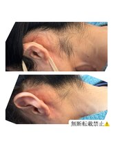 シェノン(Chainon)/脱毛