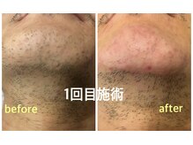 ハーチ 金沢店(8)/男性限定　美容電気脱毛60分