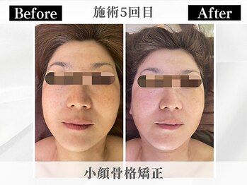 ポーベルポー(Peau Belle poe)/ 基本の小顔骨格矯正 5回目 
