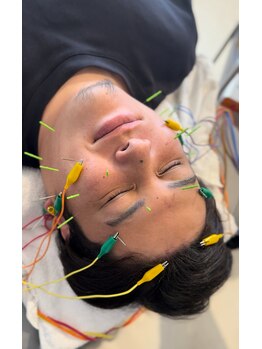 ベル(Belle)/メンズ美容鍼!