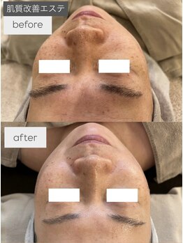 シエル(C i E L.)/肌質改善エステ