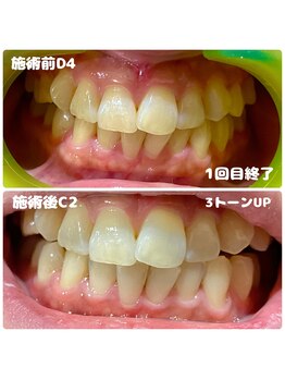 ワイズサロン(Y's salon)/結婚式の前にキレイに（1回目）