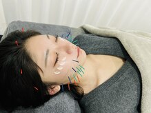 了鍼灸整骨院/食いしばり、肌荒れには美容鍼！