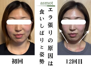 asmot鍼灸 整体院 代々木上原(asmot鍼灸 整体院)/美容鍼灸で小顔むくみスッキリ