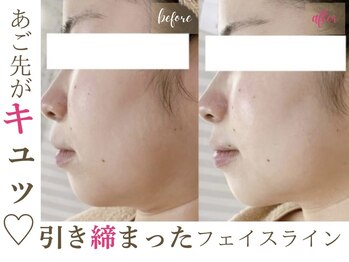 ソワンドビジュー(soin de bijew)/インディバで小顔ケア