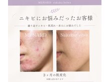 メナードフェイシャルサロン 中区平和/3ヶ月の肌変化