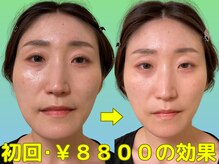 ナチュラルパーフェクトフェイス 新宿/一回で効果を実感/新宿駅小顔