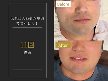 ステイゴールド 新百合ヶ丘(STAY GOLD)/おヒゲ脱毛の経過☆