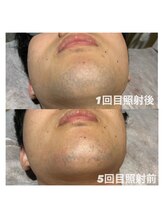 ゆいまーるはうす/メンズヒゲ脱毛5回目