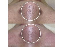 ビオルブ(VIOLVE)/毛穴エクストラクション