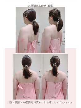 トゥインクル 麻布(twinkle)/麻布十番/シンメトリー小顔矯正