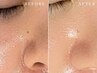 【小鼻・あごのざらつきに】産毛オフ＋毛穴超音波洗浄でつるん肌へ ¥9,900
