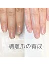 約3ヶ月で剥離爪のお悩み解消