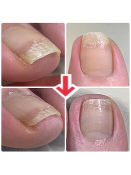 ユキネイル(YUKINAIL)/一度のカットで、痛さ、軽減!!