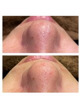 ヴェルデ 八尾/【毛穴洗浄】黒ずみコース