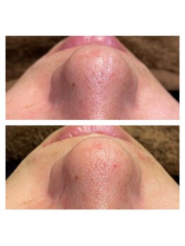 ヴェルデ 八尾/【毛穴洗浄】黒ずみコース