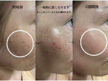 オアシス カナヤマ(Oasis kanayama)/【フェイシャル】肌質改善♪