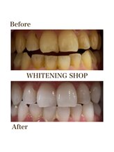ホワイトニングショップ 函館店(Whitening Shop)/Before &Afterホワイトニング