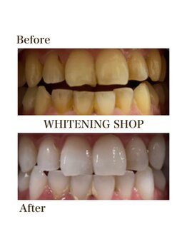 ホワイトニングショップ 函館店(Whitening Shop)/Before &Afterホワイトニング