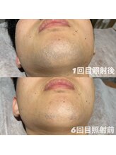 ゆいまーるはうす/メンズヒゲ脱毛6回目