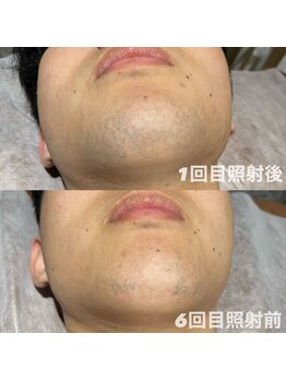 ゆいまーるはうす/メンズヒゲ脱毛6回目