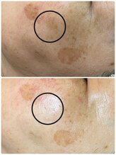 シーカラー 中野栄店(C.color)/カスタムしみケア◎50代女性