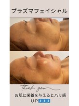 ヴィアス(Vias)/プラズマフェイシャル