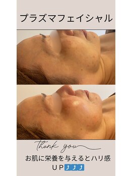 ヴィアス(Vias)/プラズマフェイシャル