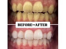 ホワイトニングサロン 豊中/Before&After美白ホワイトニング