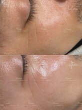 キスミー(Ksmiii)/メンズフェイシャル