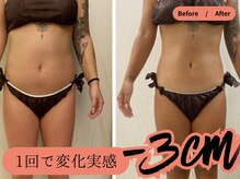 落ちにくい見た目の【下腹部】や【二の腕】頑固な脂肪はSolnis.へ！