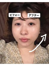 ロミハリ(LomiHari)/美容鍼 ビフォーアフター