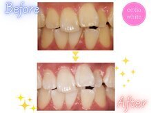 エクシアホワイトニング 前橋店/ビフォーアフター