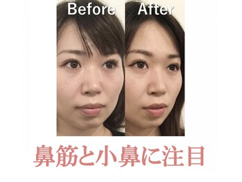 ラプリ 盛岡店(Raplit)/隆鼻＋輪郭矯正40分10回