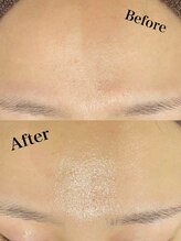 ツール(TOOL)/ハーブピーリング