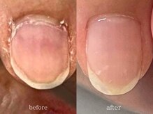 爪悩み専門店/自爪育成　症例