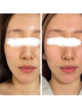 ラビ(RABBI)/30代女性小顔矯正