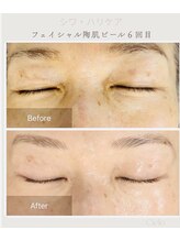 シエロ(Cielo)/フェシャル陶肌ピールでハリケア