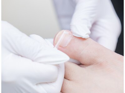 足爪補正士が長年の爪の悩みを解消。爪に負担の少ない器具を使用
