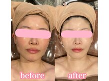 クラッシーガール ダンディエール(QlassyGirl DANDYELL)/【２０代】３回後/最速小顔