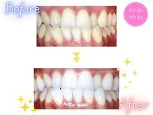 エクシアホワイトニング 前橋店/ビフォーアフター