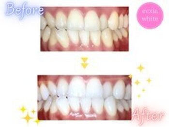 エクシアホワイトニング 前橋店/ビフォーアフター